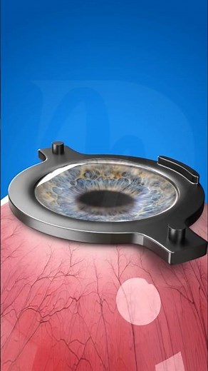 LASIK Eye Surgery – Step by Step Vision Correction Process
