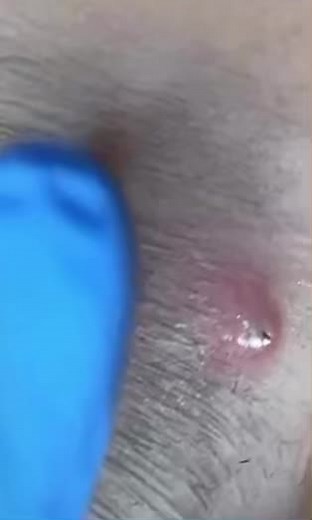 #acne #ჩირქოვანიგამონაყარი #აკნე #ღრმაწმენდა #innabella #ბათუმშილამაზდებიან #ცხიმინიკანი #აკნესსაცხი #ინნაბელლა