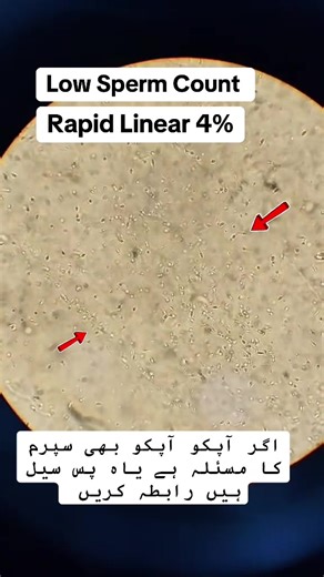 Understanding Low Sperm Count and Its Solutions