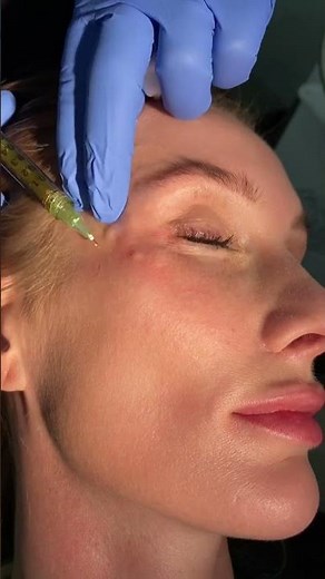 PRP FOR UNDER EYE CIRCLES & BRIGHTENING AT DR. MEDISPA