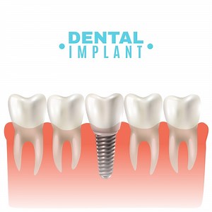 Dental Implants PERTH Cost – Best Affordable Tooth Implant Prices 2023