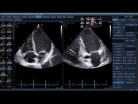 Quantifizierung der LV Funktion für Einsteiger