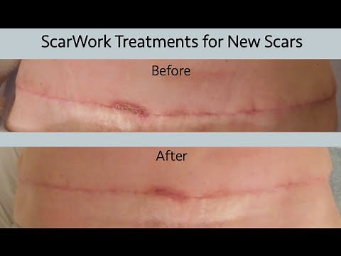 Breast Cancer Scar Therapy Using ScarWork and Scar Massage