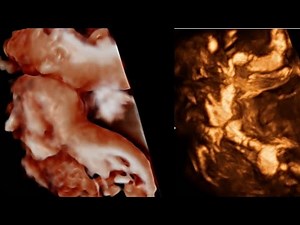 Rachischisis totalis & iniencephaly ultrasound vs segmental spinal dysgenesis (spinal dysraphism)