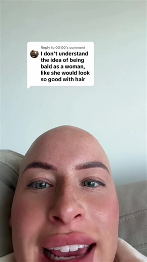 The way this was a year ago and now I’m growing some hair follicles wth #bald #alopecia #hairloss