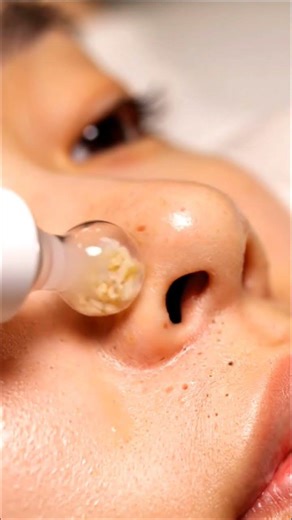 Satisfying Nose Extraction ASMR | Clean Pores Transformation