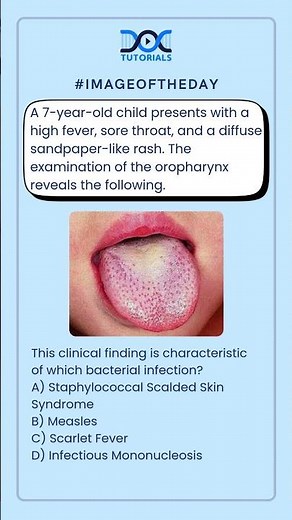 This clinical finding is characteristic of which bacterial infection?