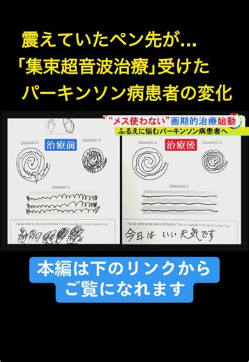 東海テレビニュースONE (@tokaitvnewsone) - 4月11日は「#世界パーキンソン病デー 」です。震えが続くというこの病気に、メスも使わない画期的ともいえる治療が、岐阜県美濃加茂市の中部国際医療センターに導入されました。 #パーキンソン病 #ニュースONE #TikTokでニュース #4月11日