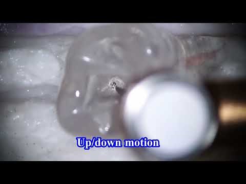 Basic broken file removal/基本的な破折器具除去