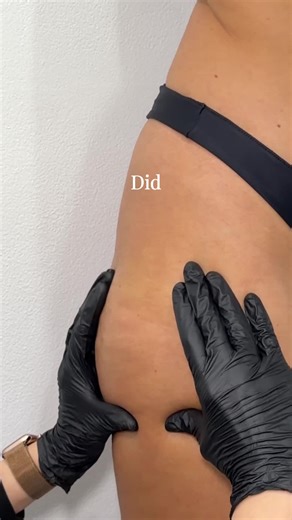 🌟 50% OFF LIPOcel Body Sculpting — Sale Ending Soon 🌟 Looking to sculpt your body and tighten your skin without surgery? LIPOcel uses advanced HIFU technology to help target stubborn fat while supporting skin tightening — all in one treatment. ✨ Non-surgical ✨ Minimal downtime ✨ Suitable for areas like the stomach and thighs Join 100,000 clients treated at Elite Body Contouring across NSW, ACT and South Australia. 📞 1300 10 10 55 💻 elitebodycontouring.com.au Offer ends 28 March. *T&Cs Apply 