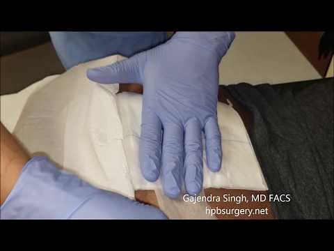 Change Dressing Pilonidal Abscess Wound at Home