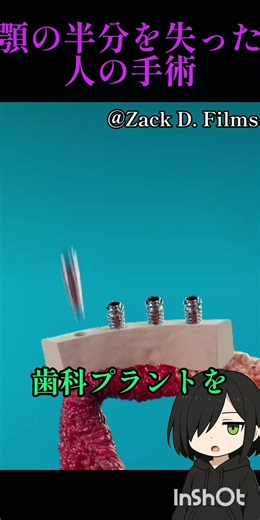 顎の半分を失った人の手術 #解説#ショート