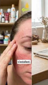 Stop your rosacea! Do this!