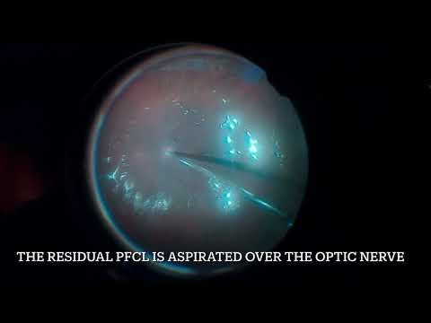 7 STEPS FOR SUCCESFUL GIANT RETINAL TEAR SURGERY