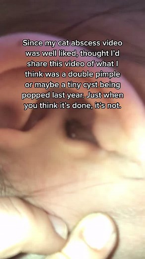 #pimplepop #pimplepopping #cyst #cystpopping @drpimplepopper #fyp #fypシ #foryou #foryoupage #satisfyingvideo #satisfyingpop