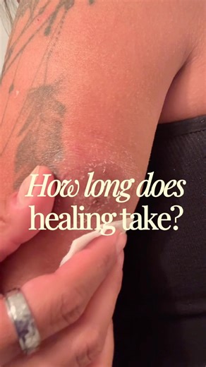 How long does a #subcutaneousremodulin site take to heal?