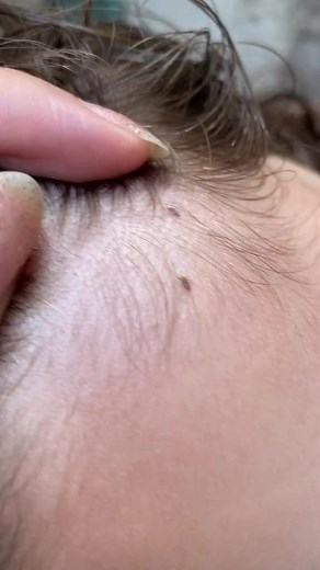 Understanding Scalp Issues: Dandruff and Follicle Health