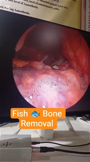 Fish 🐠 bone removal from Throat via 70 degree throat endoscopy