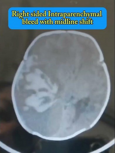 Intracranial Bleed Detection with CT Brain Scan Explained
