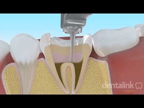 Endodoncia completa PASO A PASO - Video 3D