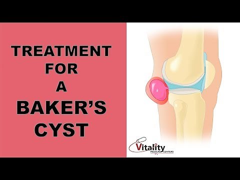 Bakers Cyst Behind the Knee: Explained by John E. Stavrakos, MD