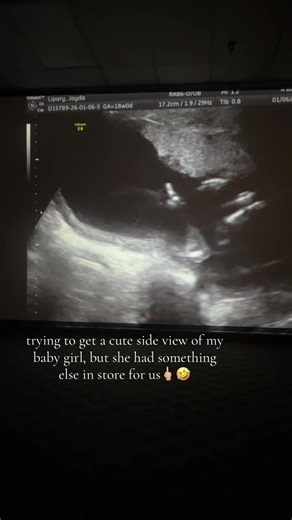 Funny Ultrasound Moment: Baby Girl Flashes the Finger