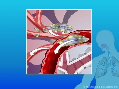 Zygomycosis: In the Immunocompromised Patient