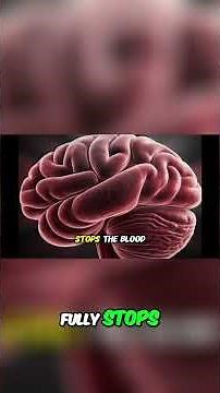 Stroke Uncovered Inside the Brain’s Battle During a Stroke