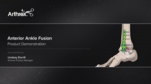 Anterior Ankle Fusion