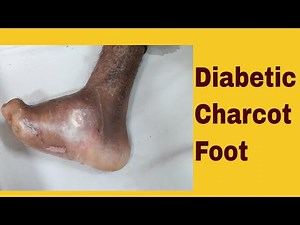 Diabetic Charcot Foot Deformity|| Diabetic Neuropathy and foot || Diabetes Complications