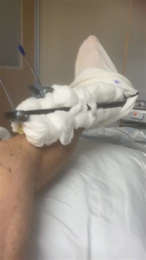 Providence Pole Fitness on Instagram: "Serious car crash I was passenger shattered tibia and fibula called a “pilon fracture (L) “ happened 11/23 in mass. Had 2 surgeries already 1 didn’t go well. Staff infection in bone. I got a long road ahead of me. Studio is in great hands!!! We are fully operational. New website design is ready And renovations taking place as well. One little step at a time. Long journey ahead! Positive vibes always! #pilonfracture #polestudio #studioowner #polefitness #roa