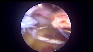 Transosseous Cuff Repair Using 2 Tunnels for Large Cuff Tear