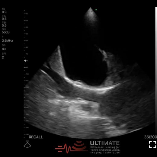 Jellyfish Sign in Lung Ultrasound - ULTİMATE