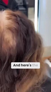 Have you seen what your follicles look like under the microscope? I...