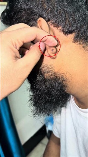 cyst need poop