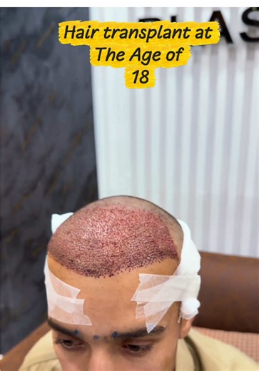 Expert Hair Transplant Services at Dr. Habib Clinic