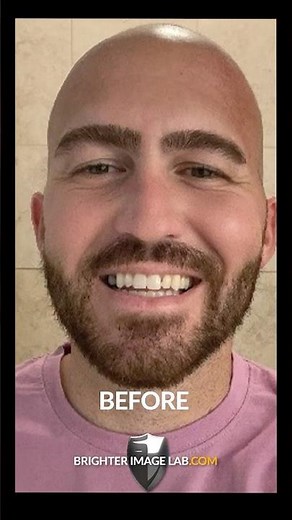This veneer transformation is INSANE 🫣