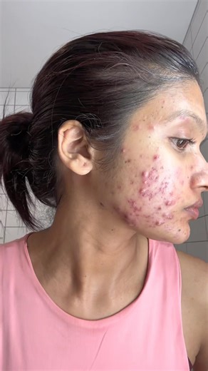 This hurt more than it looks. #cysticacne #acnejourney #acneawareness #acne