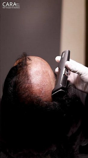 Want a PERFECT Hairline? Watch This Hair Transplant Process