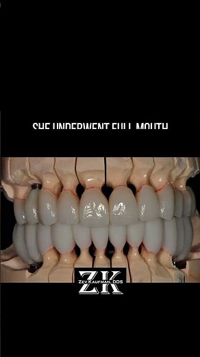 Full Mouth Rehabilitation