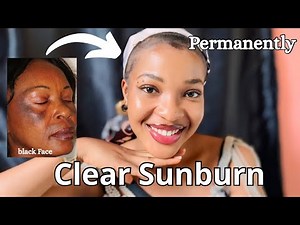 How To Treat Sunburn Quickly |How To clear Sunburn permanently