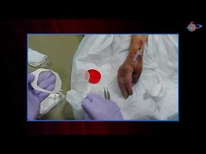 WCW: Novel Management of a Heavily Draining Wound