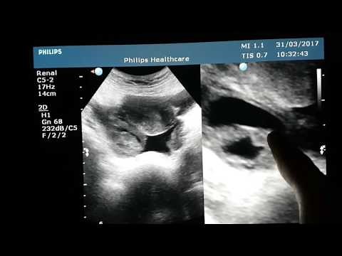 Ruptured Hemorrhagic Cyst Ultrasound