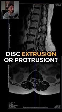 Disc Extrusion vs Protrusion on MRI