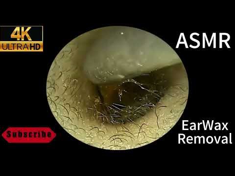 Ear Wax Removal & Ear Cleaning | Relaxing Ear Cleaning Wax Removal ASMR