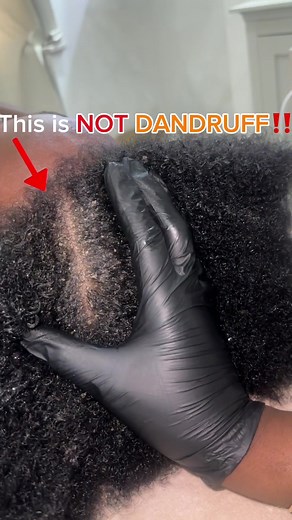 Understanding Scalp Issues: Psoriasis vs. Dandruff