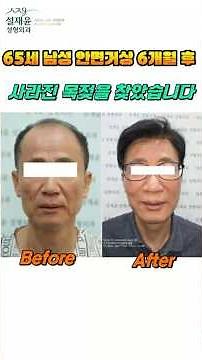 남자는 턱선이 생명! 60대 남성 안면거상 6개월 리포트