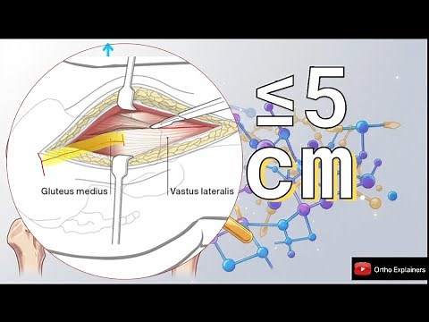 Hardinge (Hip Direct Lateral Transgluteal) approach explainer
