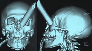 25 Strangest Things Found In An X-Ray
