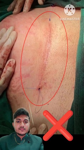 intradermal suture #cesarean #suturing #stitches #medicalshorts